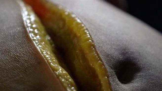 解剖后发现，女子全身都包覆着一层厚厚的“脂肪”。