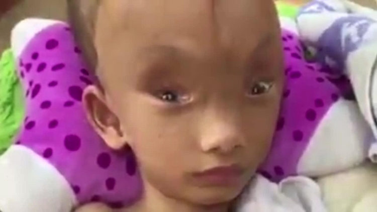 6岁男孩头颅上出现10公分裂缝父亲吓跑,祖母心碎:可以把整只手放进去...(影片)