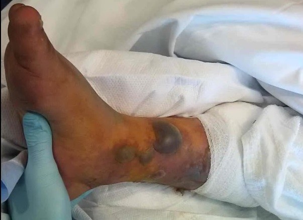 德州男子刚刺青就下水,感染海洋弧菌身亡(图/翻摄viralnova)