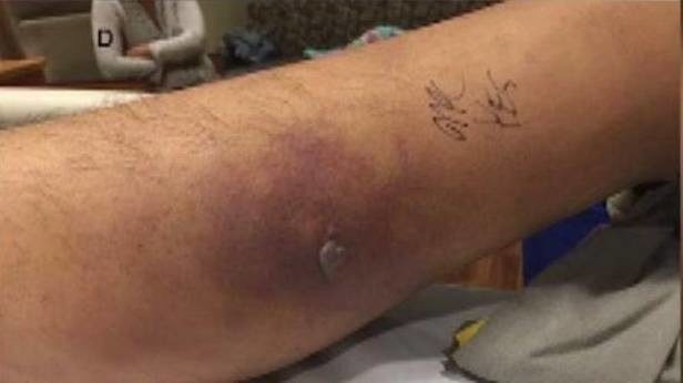 德州男子刚刺青就下水,感染海洋弧菌身亡(图/翻摄viralnova)