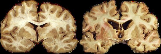 左图为正常大脑，右图为CTE患者大脑