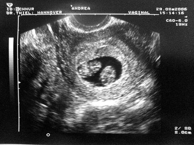 双胞胎有两个父亲的情况，发生的几率只有百万分之一。