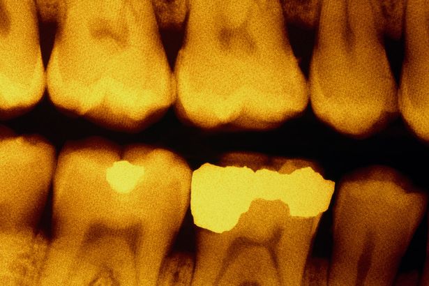 Dental-x-ray-showing-fillings
