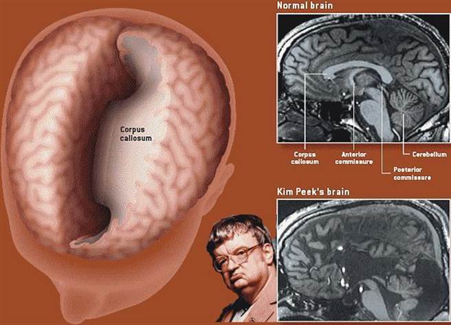 匹克的“大脑奇迹”困惑着美国专家。