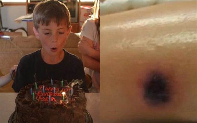 Keith Pierce因腿上“黑色印记”，引发败血症死亡。