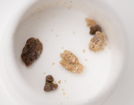 坐过山车可能有益身体健康,比如排石