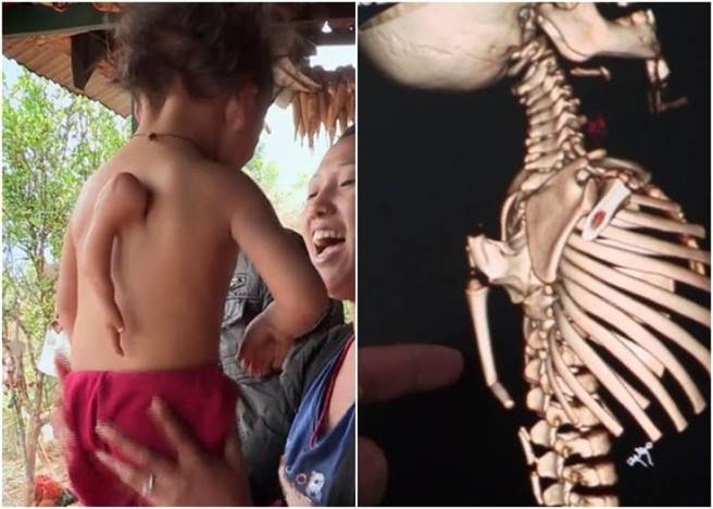 阿鲁姆(左图左)背部长有第三只手。 阿鲁姆(左图左)背部长有第三只手。