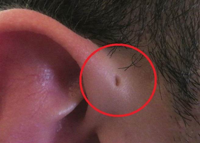 耳朵连着脸附近的位置有个小洞？专家指在亚洲人中，每100人就有4至10个人会有这种情形，被称为耳前廔管（又称耳前窦）