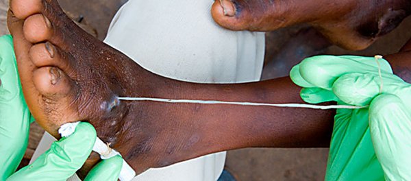 地表最强寄生虫(慎入)