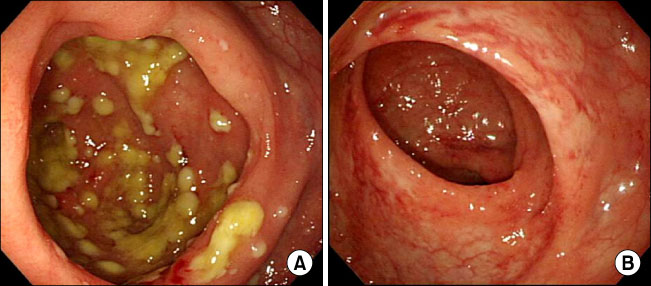 盲肠不是废物有重要功能！它从猿人到人类一直没有消失因为很重要！