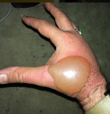 阳光下挤莱姆 竟害他手背冒出“鸡蛋大水泡”。（图／翻摄instagram／adamlevy）